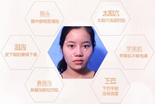 自体脂肪填充术