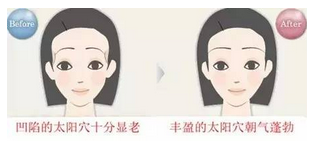自体脂肪填充术