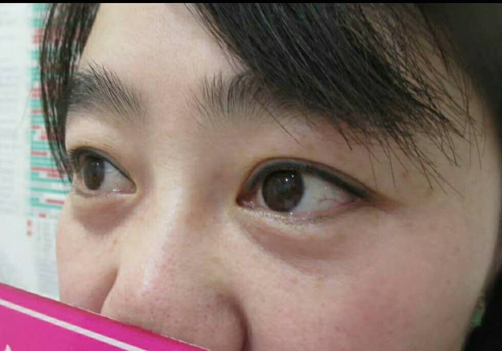 长效玻尿酸填充泪沟