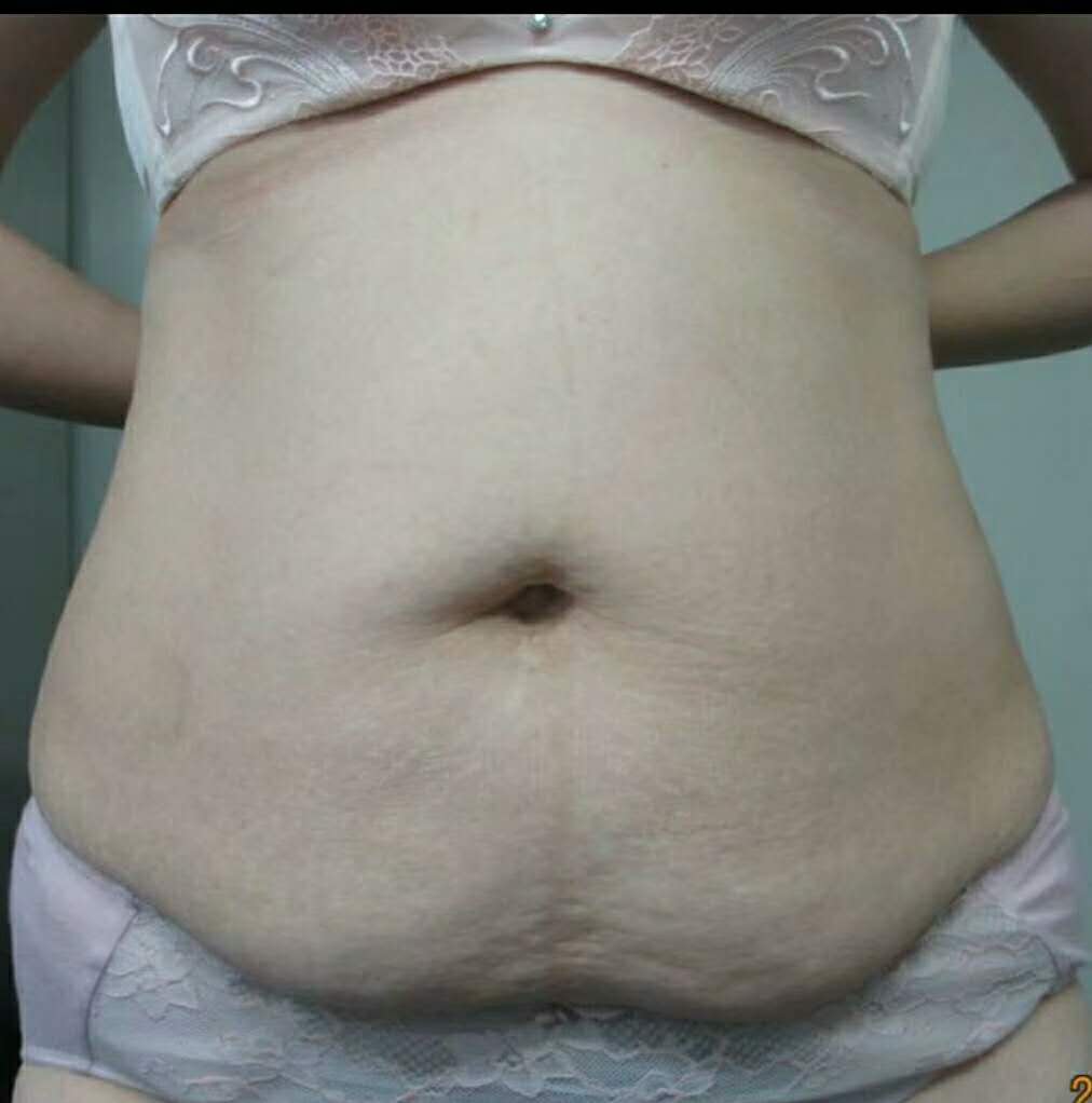 吸脂减肥