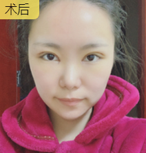 双眼皮手术