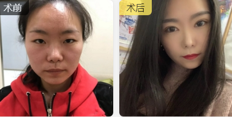 双眼皮手术