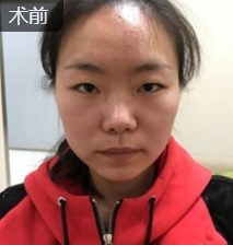 双眼皮手术
