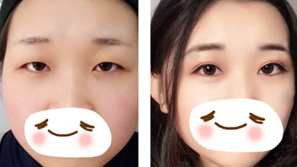 双眼皮手术