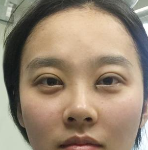双眼皮手术