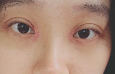 双眼皮手术