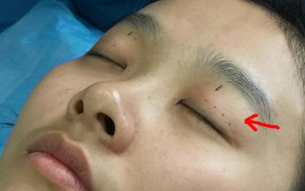 双眼皮手术