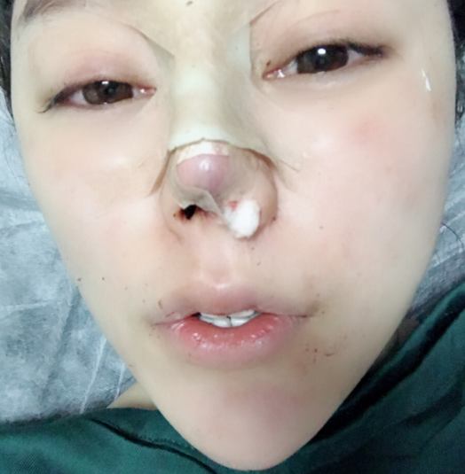 隆鼻手术