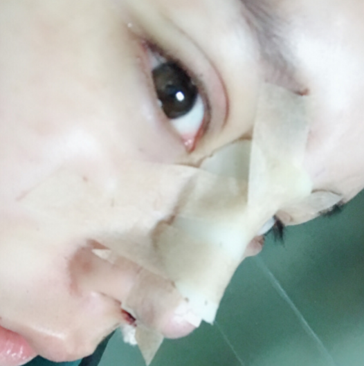 隆鼻手术