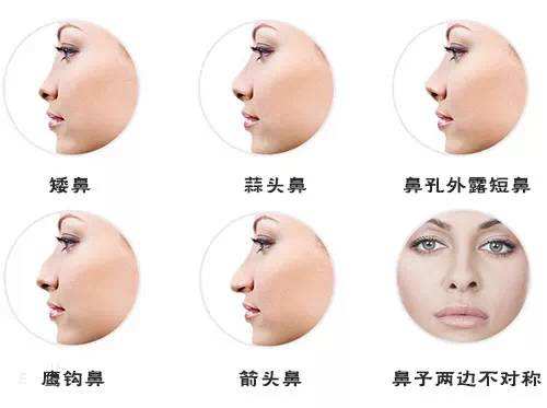 隆鼻手术