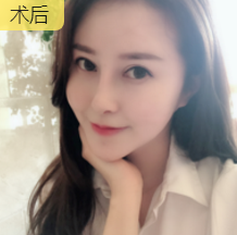隆鼻手术