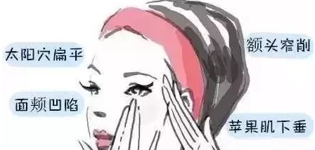 自体脂肪填充术