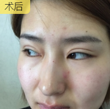 双眼皮手术