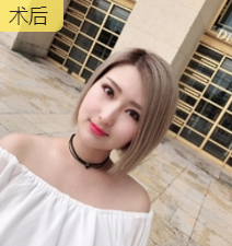 双眼皮手术