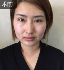 双眼皮手术