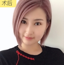 双眼皮手术
