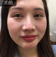 双眼皮手术