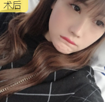 双眼皮手术