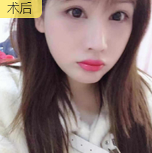 双眼皮手术