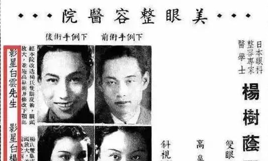 双眼皮手术