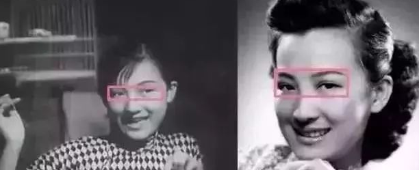 双眼皮手术
