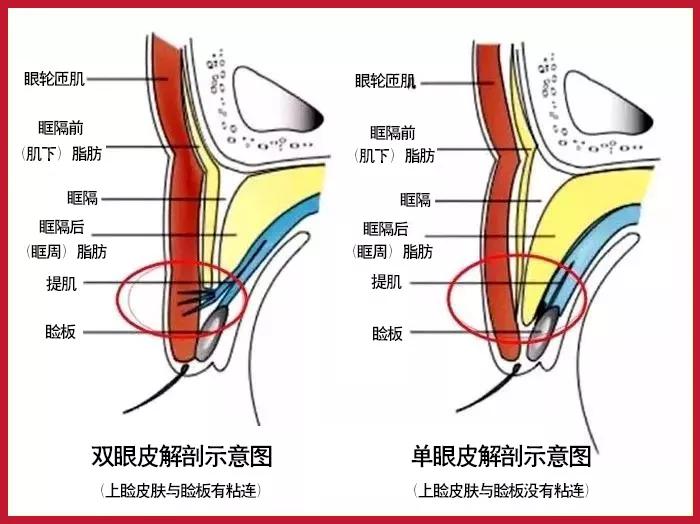 双眼皮手术