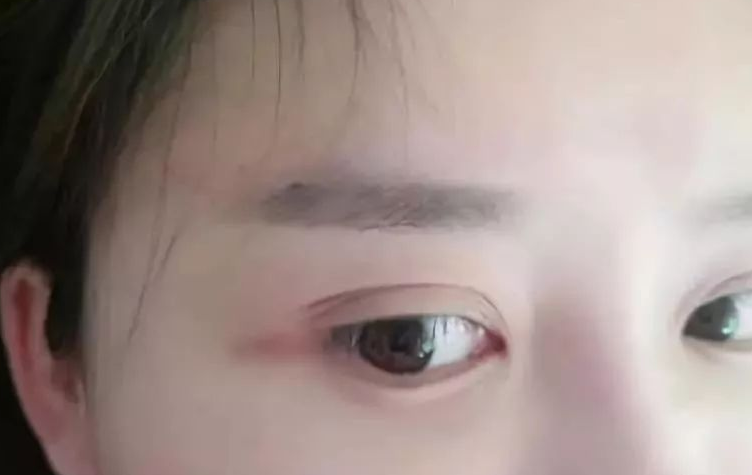 自体脂肪填充术