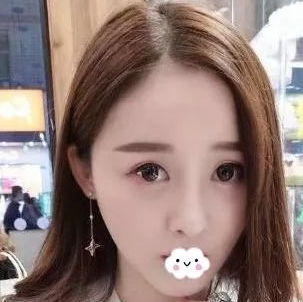 自体脂肪填充术