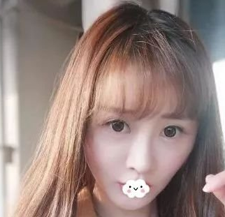 自体脂肪填充术