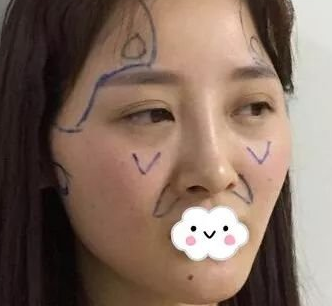 自体脂肪填充术