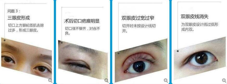 双眼皮手术