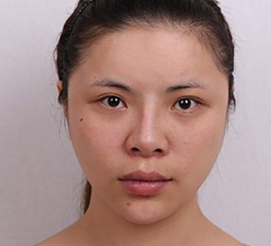 不开刀下巴延长术