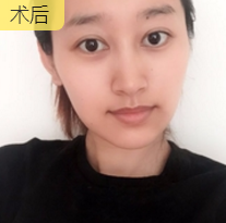 不开刀下巴延长术