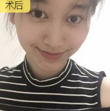 不开刀下巴延长术