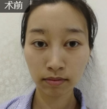 不开刀下巴延长术