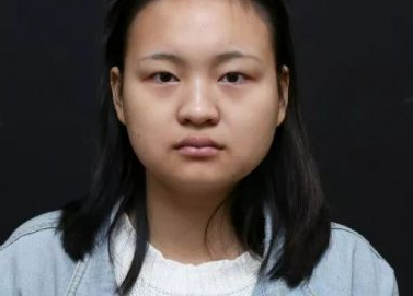 双眼皮手术