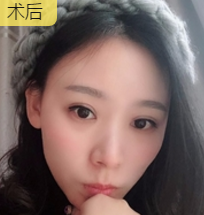 双眼皮手术