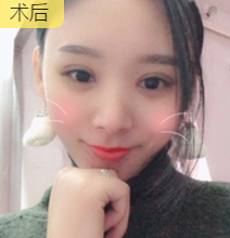 双眼皮手术