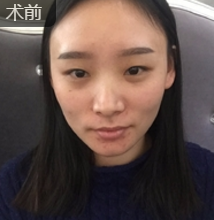 双眼皮手术