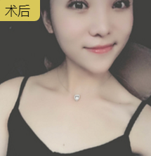 双眼皮手术