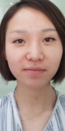 双眼皮手术