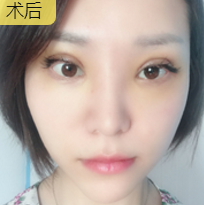 双眼皮手术