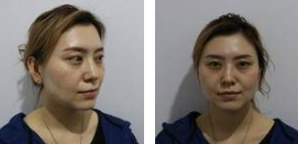 长效玻尿酸填充术