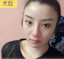 去双下巴