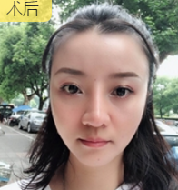 去双下巴