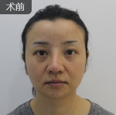 去双下巴
