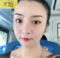 去双下巴