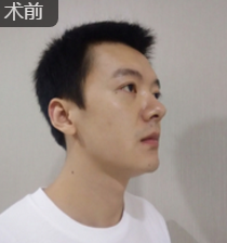 面部提升术