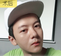 面部提升术