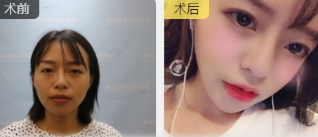 玻尿酸丰唇